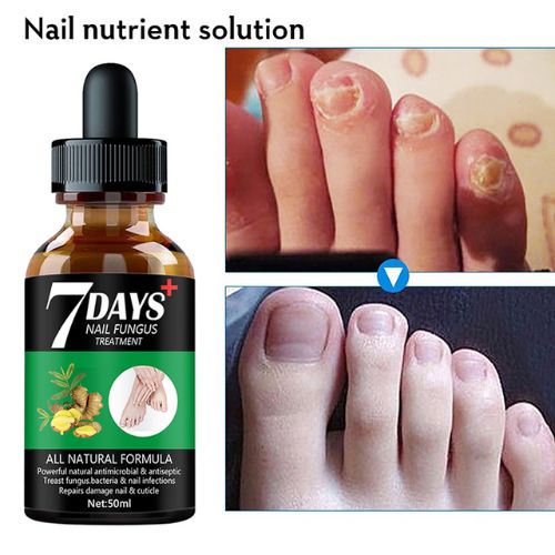 ALL NATURAL 7-Day Toenail Fungus Treatment